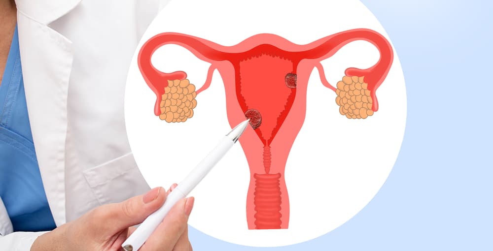 No momento, você está visualizando Câncer de útero apresenta maior risco em casos de excesso de peso em mulheres