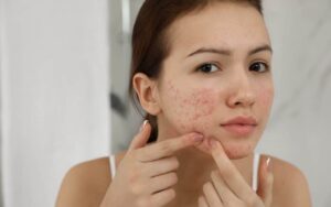 Leia mais sobre o artigo Estudo relaciona as acnes a deficiência de ômega-3