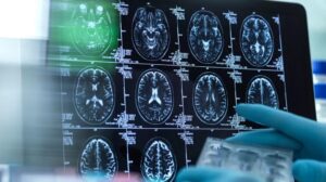 Leia mais sobre o artigo Cientistas criam método para tratar da epilepsia mais rápido