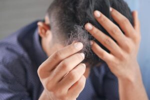 Leia mais sobre o artigo FDA aprova 1º remédio para alopecia que restaura cabelos