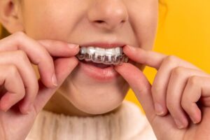 Leia mais sobre o artigo Entenda a diferença entre aparelhos e alinhadores dentários