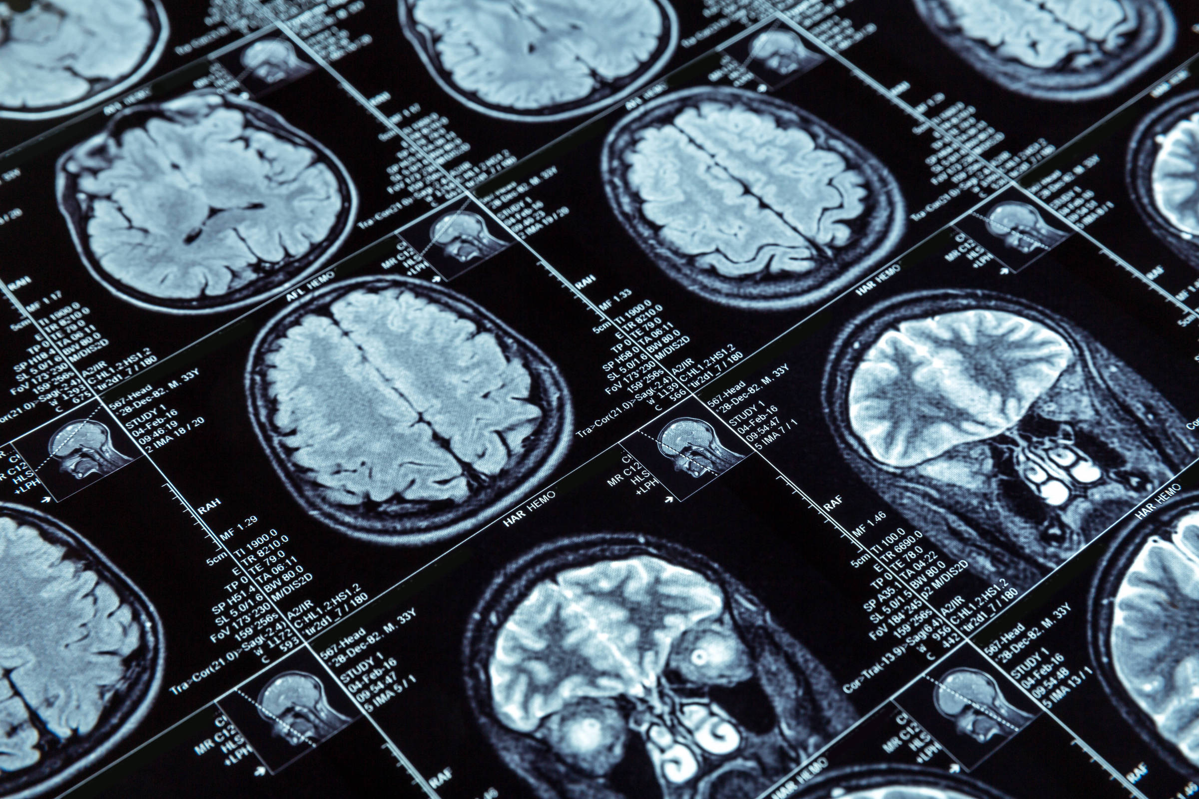 No momento, você está visualizando Relação entre doenças intestinais e mal de Alzheimer se confirma