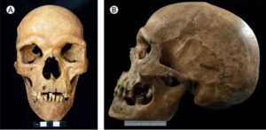 Leia mais sobre o artigo Descoberto esqueleto de mil anos com condição genética rara