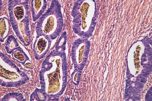 No momento, você está visualizando Bactéria da Amazônia pode combater câncer de intestino