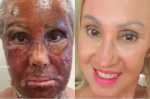 Leia mais sobre o artigo Mulher ‘troca de rosto’ após procedimento estético e viraliza
