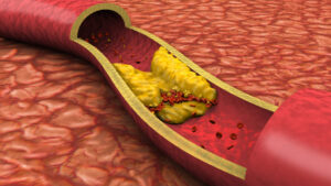 Leia mais sobre o artigo Primeiro sinal de alerta de colesterol alto pode aparecer à noite