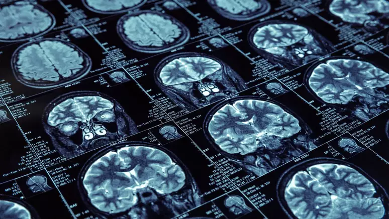 No momento, você está visualizando Remédio que silencia proteína promete retardar o Alzheimer