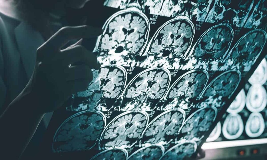 Você está visualizando atualmente Estudo revela sinal precoce de Alzheimer