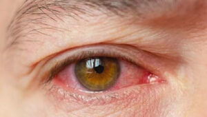 Leia mais sobre o artigo Julho Turquesa busca conscientizar população sobre a síndrome do olho seco