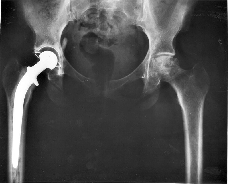 Você está visualizando atualmente Simples mudança pode tornar implantes de quadril e joelho mais seguros; saiba qual