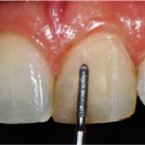 No momento, você está visualizando Implante dentário promete devolver sensibilidade ao sorriso