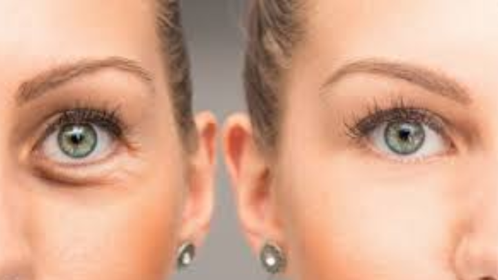 No momento, você está visualizando Blefaroplastia segura previne complicações graves