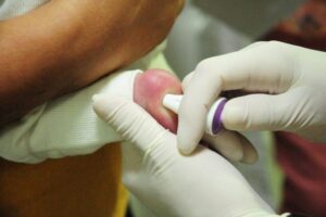 Leia mais sobre o artigo MT Hemocentro atende 599 pacientes com a doença falciforme