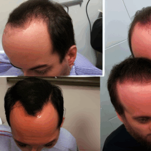 Leia mais sobre o artigo App usa IA para ajudar calvos a detectar queda de cabelo