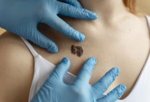 Leia mais sobre o artigo IA combina imagem e dados clínicos e detecta câncer de pele agressivo