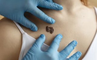 sistema-ia-consegue-identificar-melanoma